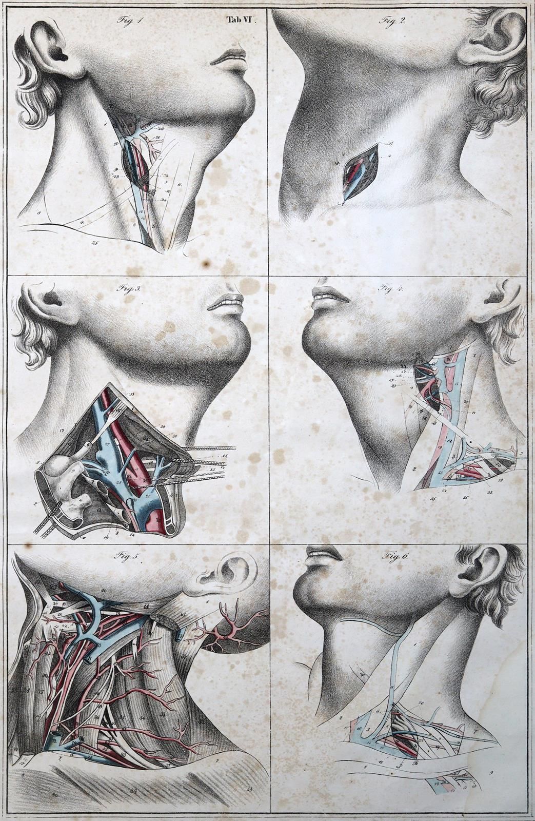 Blasius,E. 外科插图或描写血腥的外科手术和发明的工具，以消除本。仅限Atlas。大对开本，有50张（10张部分彩色）石版画，1页。(标题)。旧皮革（摩&hellip;