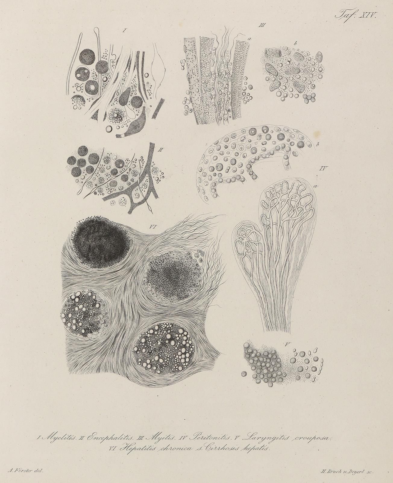Förster,A. Atlas of microscopic pathological anatomy. 2 vols. In 1 vol. Lzg, Vos&hellip;