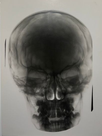 null Radiograph

Human Skull, "Intracranial Hypertension Fingerprint in a Young Subject,"...