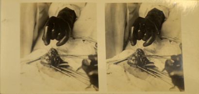 null Médecine, appendicectomie et ablation d'un sein, vers 1910
Surprenant album...