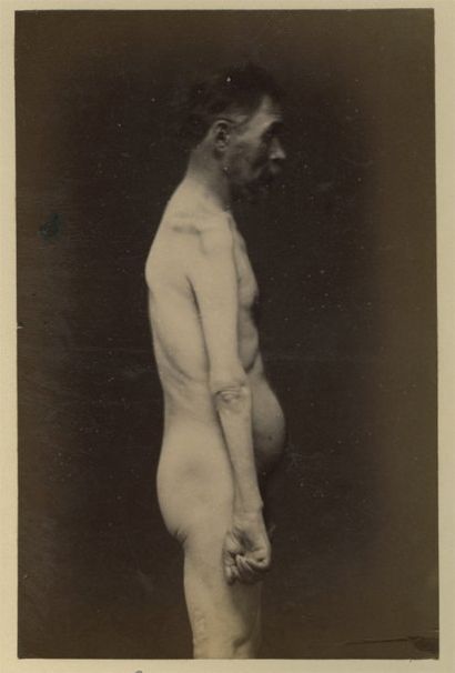 Albert Londe (1858-1917) Laurent Henri Bicêtre, 1887, face, dos, profil, 3 épreu...