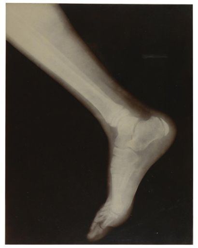 WILSON NOBEL Radiographie d'un pied Paris, ca. 1898 Collodion printing-out paper,...