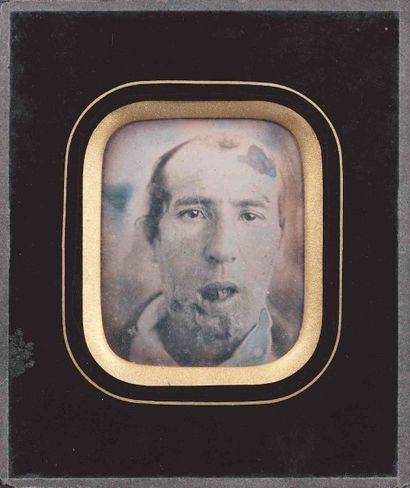 null [MÉDECINE-DAGUERRÉOTYPE]. Portrait d’homme au visage déformé. Années 1850. Daguerréotype...