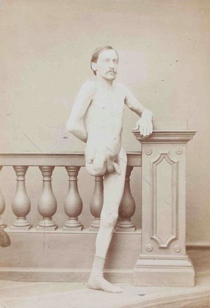 null Pierre-Ambroise RICHEBOURG, Pierre WARNER (1810-1875). Homme amputé de la jambe...