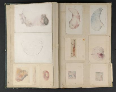 null [MANUSCRIT] - LANCEREAUX, Etienne & LACKERBAUER, Pierre - Atlas d'anatomie pathologique....