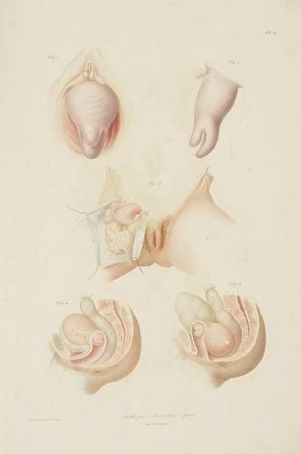 BOIVIN (Marie-Anne) - DUGÈS (Antoine-Louis) Traité pratique des maladies de l'utérus...