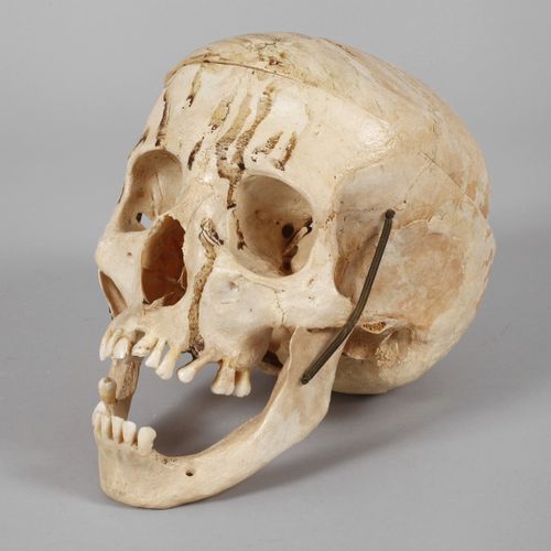 Null 
医学模式
年龄不确定，人类头骨，有开口的头盖和用弹簧铰接的下颌关节，物质流失，有岁月的痕迹，高约18厘米。