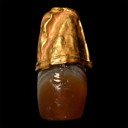 Western Asiatic Gold Capped Banded Agate Bead. 1st