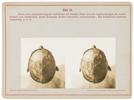 Medicina - Heiderich, Friedrich. Immagini stereosc
