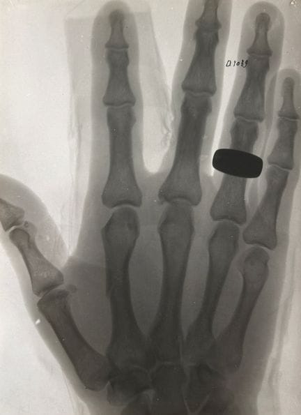 RADIOGRAPHIE - ANONYME
Radiographie d'une main bag