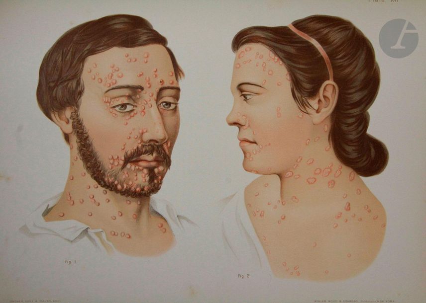 MORROW (Prince Albert).
Atlas of skin and venereal diseases.
New York : William Wood & Company, [1889]. — In-folio, demi-chagrin noir, dos à nerfs orné, tranches mouchetées.
Édition originale du plus célèbre ouvrage de Morrow, l'un des premiers dermatologues américains du XIXe siècle, portant sur les maladies dermatologiques et vénériennes.
Elle est illustrée de quelques figures dans le texte et de 75 très belles planches chromolithographiées en couleurs.
Frottements d'usage aux mors et au dos. Rousseurs éparses.