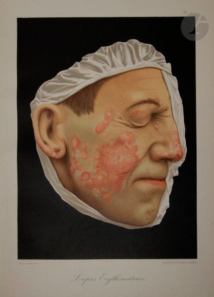 BESNIER (Ernest) - FOURNIER - TENNESON - HALLOPEAU, etc.
Le Musée de l’hôpital Saint-Louis. Iconographie des maladies cutanées et syphilitiques avec texte explicatif.
Paris : Rueff et Cie, [1895-1897]. — In-folio, demi-chagrin rouge, dos à nerfs, tranches mouchetées (relire de l'époque).
Édition originale de l’un des ouvrages dermatologiques et syphiligraphiques les plus réussis.
Publié en 50 fascicules entre 1895 et 1897, il donne la reproduction de quelques-uns des plus beaux moulages du Musée de l’Hôpital Saint-Louis, exécutés par M. Baretta, représentant différents cas de maladies cutanées et syphilitiques.
L'illustration se compose de très nombreuses gravures sur bois et reproductions photographiques dans le texte ainsi que de 50 superbes planches en couleurs représentant les dits moulages.

Exemplaire relié sans la préface de Henri Feulard.
Dos frotté, fentes aux charnières, coins émoussés, tâches sur les plats.
