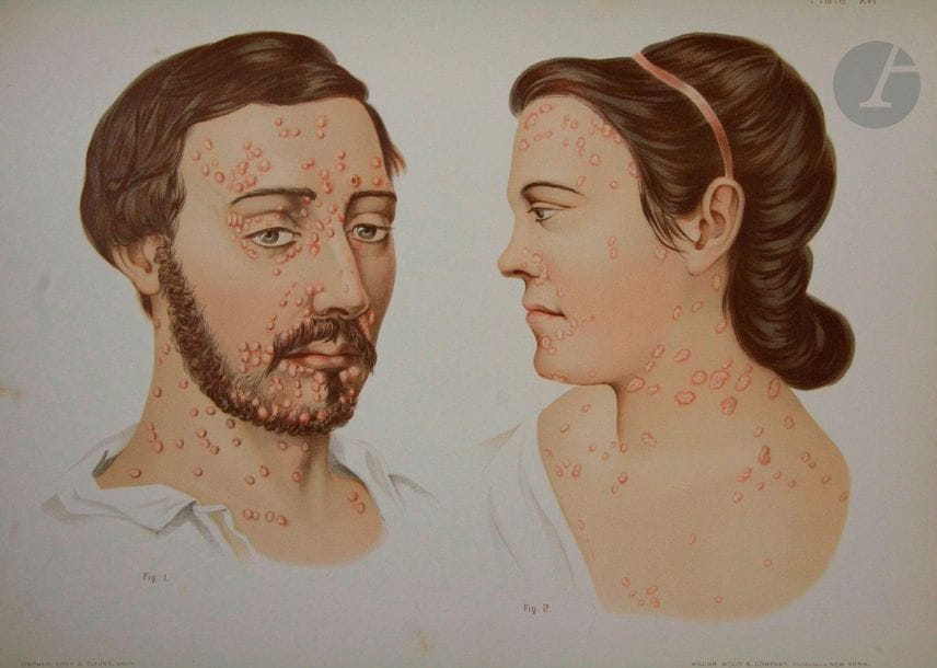 MORROW (Prince Albert).

Atlas of skin and venereal diseases.

New York : William Wood & Company, [1889]. — In-folio, demi-chagrin noir, dos à nerfs orné, tranches mouchetées.

Édition originale du plus célèbre ouvrage de Morrow, l'un des premiers dermatologues américains du XIXe siècle, portant sur les maladies dermatologiques et vénériennes.

Elle est illustrée de quelques figures dans le texte et de 75 très belles planches chromolithographiées en couleurs.

Frottements d'usage aux mors et au dos. Rousseurs éparses.