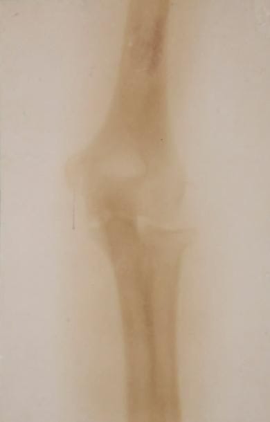 Photographie Médicale. Radiographie du genou, 1905. Epreuve au citrate d'époque, contrecollée sur carton avec signature du médecin : "Ch. Vaillant. 123 Rue Caulaincourt. Paris. Avirl 1905". 23 x 14,7 cm. Charles Vaillant (1872-1939) fut un pionnier de la radiologie française. 