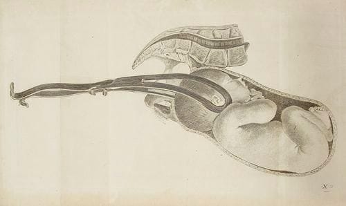 BAUDELOCQUE (Jean-Louis)
L'Art des accouchemens. Paris: Méquignon l'aîné, 1796 - An Veme de la République française. - 2 volumes in-8, lv, 496 pp., 7 pl.; (2 ff.), viij, 603 pp., 10 pl. Basane racinée, dos à nerfs orné, tranches rouges (reliure de l'époque). Troisième édition très augmentée de cet ouvrage publié pour la première fois en 1781. Jean-Louis Baudelocque (1745-1810) était considéré comme le plus habile accoucheur du XVIIIe siècle et du début du XIXe siècle. Son Art des accouchements est composé sur le même plan que ses Principes de l'art des accouchements publiés en 1775, mais s'adresse spécifiquement aux médecins et chirurgiens; il est par ailleurs beaucoup plus étendu. Il se divise en 4 parties que l'auteur décrit ainsi: "La première renferme les connoissances anatomiques & physiologiques essentiellement nécessaires à l'Accoucheur. La seconde traite du mécanisme de l'Accouchement naturel, & de la délivrance, ainsi que des premiers soins qu'on doit à la mère & à l'enfant. La troisième a pour objet l'accouchement contre-nature; & la quatrième le laborieux, avec ce qui a rapport à la grossesse de plusieurs enfans, aux fausses-grossesses & à l'avortement" (p. xxij). L'édition est illustrée de 17 planches dépliantes gravées par Devisse d'après Chailly. Coiffes arrachées, petites fentes aux mors, épidermures, coins émoussés. Mouillure dans le premier volume.