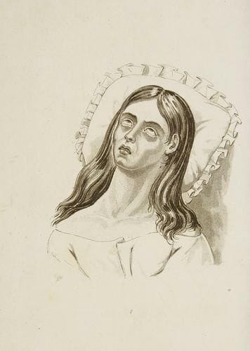 ROZIER
Des habitudes secrètes ou des maladies produites par l'onanisme chez les femmes. Paris: Audin, 1830. - In-8, front., (2 ff.), 321 pp., (1 f.), 3 pl. Demi-veau havane, dos lisse orné, tranches marbrées (reliure de l'époque). Troisième édition, corrigée, de ce traité sur les méfaits de la masturbation féminine, composé par le docteur Rozier et publié pour la première fois en 1825. Il s'agirait en réalité de la seconde édition du livre puisque tous les exemplaires rencontrés à la date de 1825 portent sans exception la mention de "deuxième édition", mention qui serait à notre avis fictive. L'auteur donne une suite de lettres adressées à une demoiselle, exposant différents cas tirés de la littérature médicale et de l'expérience de l'auteur, qui ne font que reprendre ceux déjà exposés par Tissot. Il y présente de façon dramatique les maladies et pathologies qu'encourent les filles s'adonnant à la masturbation, résumées dans la seconde lettre: "Les personnes livrées à l'égarement de la solitude... présentent plus ou moins promptement les symptômes de la consomption dorsale; elles n'ont point dès l'abord de fièvre; cependant, quoiqu'elles conservent de l'appétit, leur corps maigrit et se consume; il leur semble que des fourmis leur descendent de la tête le long de l'épine. La marche, de simples promenades même, surtout dans des routes difficiles, les essoufflent, les affaiblissent, leur occasionnent des sueurs, des pesanteurs de tête et des bruits d'oreilles; il survient des maladies du cerveau et des nerfs, de la stupidité et de l'imbécillité..." (pp. 4-5), et la liste continue. L'intérêt ou l'originalité du livre réside avant tout dans les quatre illustrations représentant l'état dans lequel peuvent se trouver les femmes s'adonnant à la masturbation et qui ne se trouvaient pas dans l'édition précédente. La gravure placée en frontispice n'est que la représentation allégorique de l'onanisme et de ses conséquences. Un mors fendu. Rousseurs.