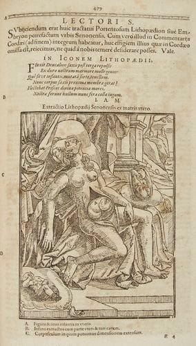 SPACH (Israel)
Gynæciorum sive de mulierum tum communibus, tum gravidarum, parientium, et puerperarum Affectibus & Morbis. Argentinæ (Strasbourg): Lazari Zetzneri, 1597. - In-folio, (18 ff.), 28, 1082 pp. ch. 1080, (17 ff.). Veau brun, dos à nerfs orné, tranches rouges (reliure du XVIIe siècle). Brunet, 5, 470. Rare et intéressant recueil publié par le médecin strasbourgeois Israel Spach (1560-1610). Il s'agit de la plus importante compilation du XVIe siècle de textes gynécologiques et obstétriques, faite à partir du Gynaeciorum publié en 1566 par Gaspard Wolff auquel Spach a rajouté plusieurs autres traités. La collection réunit des études d'Ambroise Paré, Félix Platter, Girolamo Mercurial, Ludovico Bonaccioli, Albertino Bottoni, Giovanni Battista da Monte, etc. L'édition est illustrée de plusieurs bois gravés dans le texte représentant des figures anatomiques, tirées essentiellement de Vésale, ainsi que des instruments chirurgicaux. Dos restauré, mors fendus, frottements et épidermures sur les plats, coins émoussés. Feuillet D4 déchiré sans manque, rousseurs. Quelques notes modernes au stylo et au crayon. Réparation au titre sur lequel figure également un ex-libris manuscrit ancien biffé.