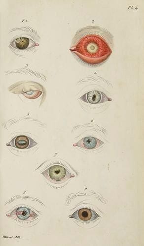 WELLER (Carl Heinrich)
Traité théorique et pratique des maladies des yeux. Paris: Villeret et Cie, 1828. - 2 volumes in-8, (2 ff.), VII, 396 pp.; (2 ff.), III, 320 pp., 6 pl. Demi-basane fauve, dos lisse orné, tranches jaspées (reliure de l'époque). Première édition française faite d'après la 3e édition allemande de 1826, de ce traité d'ophtalmologie destiné aux médecins désireux de pratiquer cet art, composé par le médecin oculiste de Dresde Carl Heinrich Weller (1794-1854). Cet ouvrage eut un très grand succès aussi bien auprès des élèves qu'auprès des praticiens. Il contient tout ce que l'on pouvait savoir à l'époque. Commençant par un chapitre sur l'ophtalmie simple en général, l'auteur poursuit par les Maladies des enveloppes externes de l'oeil, les Maladies des parties situées entre l'orbite et le globe de l'oeil, les Maladies du globe de l'oeil, les Maladies de la rétine et du nerf optique, les Maladies qui affectent à la fois les parties opaques et les parties transparentes de l'oeil, les Maladies qui affectent la totalité du bulbe oculaire et les Ophtalmies spécifiques. Un Appendice contient la manière de préparer les médicaments, la Nouvelle méthode pour produire artificiellement l'opacité du crystallin sur les cadavres, etc. La traduction est due à f. J. Riester et les notes au docteur Jallat. Bibliographie ophtalmologique en tête du premier volume. L'édition est illustrée de 6 planches dont 1 dépliante. Les 4 premières sont des lithographies en couleurs représentant différents types de maladie des yeux. Coiffes de tête arrachées, manque de cuir au premier caisson du premier volume, dos frottés et passés, fentes aux mors. Rousseurs.