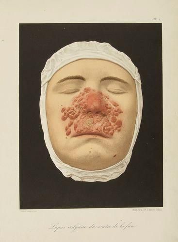 BESNIER (Ernest)-FOURNIER - TENNESON - HALLOPEAU, etc
Le Musée de l'hôpital Saint-Louis. Iconographie des maladies cutanées et syphilitiques avec texte explicatif. Paris: Rueff et Cie, (1895-1897). - 2 volumes in-folio dont 1 atlas, (1 f.), IV, 6 pp., (1 f. bl.), pp. (7)-12, (1 f. bl.), pp. (13)-29, (1 f. bl.), 4 pp., pp. (35)-52, (1 f. bl.), pp. (53)-73, (1 f. bl.), pp. (75)-84, (1 f. bl.), pp. (85)-94, (1 f. bl.), pp. (95)-258, 4 pp., pp. (263)- 346, (1 f.); (1 f.), 50 pl. Demi-chagrin brun, dos à nerfs orné, tranches jaspées (reliure de l'époque). Édition originale de l'un des atlas dermatologiques et syphiligraphiques les plus réussis. Publié en 50 fascicules entre 1895 et 1897, il donne la reproduction de quelques-uns des plus beaux moulages du Musée de l'Hôpital Saint-Louis représentant différents cas de maladies cutanées et syphilitiques, exécutés par M. Baretta. L'atlas comporte 50 planches en couleurs qui sont chacune accompagnées, dans un volume à part, d'une notice rédigée par le médecin même qui a fait exécuter le moulage. Le volume comprenant ces notices est également illustré de reproductions en noir dans le texte. Bon exemplaire malgré quelques frottements aux dos et les coins émoussés.