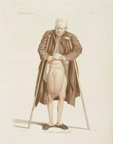 ALIBERT (Jean-Louis)
Nosologie naturelle, ou les maladies du corps humain distribuées par familles. Paris: Caille, Ravier, 1817. - In-folio, (3 ff.), lxxxviij, 616 pp., 24 pl. Demi-maroquin vert sombre à long grain, dos lisse orné, non rogné (reliure de la seconde moitié du XIXe siècle). Édition originale de cette publication ambitieuse et luxueuse dont seul le premier tome parut. Le baron Jean-Louis Alibert (1768-1837) était dermatologue et médecin personnel de Louis XVIII et de Charles X. Avec cet ouvrage il se proposait de décrire les maladies du corps humain et d'en établir un classement à partir des organes dont elles tirent leur origine. Ce premier volume décrit 10 familles: Les Gastroses - Les Entéroses - Les Choloses - Les Uroses - Les Pneumonoses - Les Angioses - Les Leucoses - Les Adénoses - Les Ethmoplécoses - Les Blennoses. L'édition est illustrée de 24 remarquables planches gravées sur cuivre en couleurs par Tresca d'après Maurice et Valvile. L'ouvrage, imprimé sur papier vélin fort, devait comprendre 2 volumes mais le coût de fabrication empêcha la parution du second volume. Frottement sur les plats, dos en grande partie décollé, petits trous de vers. Galeries de vers dans les marges de plusieurs feuillets, sans atteinte au texte, petite mouillure dans la marge supérieure des derniers feuillets.