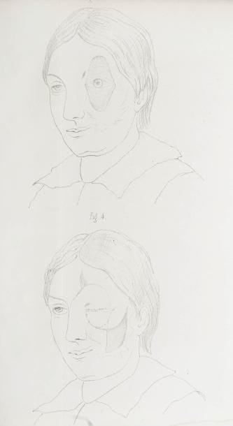 [MÉDECINE] IVERNOIS (Louis d')
Essai sur la torsion des pieds (pieds bots), et sur le meilleur moyen de les guérir. Paris: chez l'auteur, de l'imprimerie de A. Bobée, 1817. - Brochure in-8, 43 pp., 1 planche. Demi-maroquin grenat à la bradel, dos lisse orné (Lobstein-Laurenchet). Édition originale de cet essai composé par l'orthopédiste Louis d'Ivernois (1789-1844). Elle est illustrée d'une planche dépliante représentant 6 figures de pieds et un schéma de la machine de Venel permettant d'abaisser le talon et suppléer à l'action des muscles extenseurs paralysés. Cette machine est décrite dans le dernier chapitre de l'essai. Bel exemplaire relié par Lobstein-Laurenchet. On joint: - BARTH. Des rétrécissements et des obligations spontanées de l'aorte. Thèse présentée et soutenue à la Faculté de Médecine de Paris, le 6 juillet 1837; Par J.-B.-P. Barth, de Sarreguemines (Moselles). Paris: imprimerie et fonderie de Rognoux et Ce, 1837. - In-4, 29 pp. Demi-maroquin bleu nuit à la bradel, dos lisse orné (Lobstein-Laurenchet). - CAZELLES (Émile-Honoré). Thèse pour le doctorat en médecine, Présentée et soutenue le 30 juin 1860. Du traitement de l'ectropion cicatriciel. Paris: Rignoux, 1860. - In-4, 100 pp., 3 planches. Demi-maroquin noir à la bradel, dos lisse orné (Lobstein-Laurenchet). Illustrée de 3 planches dont 1 dépliante, contenant 9 figures. Mouillures claires. - DUCHENNE. Du pied plat-valgus par paralysie du long péronier latéral et du pied creux-valgus par contracture du long péronier latéral (pied creux-valgus non encore décrit), mémoire présenté à la société de chirurgie de Paris par le docteur Duchenne (de Boulogne). [suivi de]: BOUVIER. Rapport sur le mémoire de M. Duchenne... [Paris: imprimerie L. Martinet, s.d.]. - In-4, 42 pp. Demi-maroquin grenat à la bradel, dos lisse orné (Lobstein-Laurenchet). Extrait des Mémoires de la société de chirurgie de Paris.