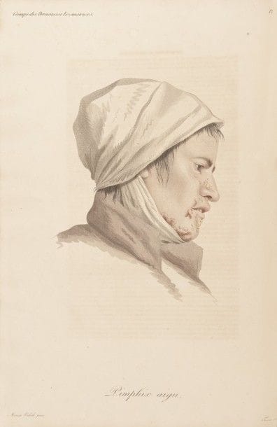 ALIBERT (Jean-Louis).
Clinique de l’hôpital Saint-Louis, ou traité complet des maladies de la peau, contenant la description de ces maladies et leurs meilleurs modes de traitement.
Paris, Lyon : B. Cormon et Blanc, 1833. — Grand in-folio, 554 x 355 : (2 ff.), xxiv, 390 pp., 63 planches. Demi-maroquin rouge à coins, roulettes à froid, dos lisse orné de motifs à la cathédrale à froid et d’encadrements dorés, non rogné (reliure de l’époque).

Seconde édition rare, revue et très augmentée, de cette monumentale et admirable publication sur les maladies de la peau, certainement le plus grand et le plus spectaculaire des livres publiés sur ce sujet.
Le baron Jean-Louis Alibert (1768-1737) était médecin en chef de l’hôpital Saint-Louis, dermatologue et médecin personnel de Louis XVIII et de Charles x ; il est considéré comme le fondateur de la dermatologie en France. Cet ouvrage parut pour la première fois à très petit nombre entre 1806 et 1814 mais sous la forme d’un recueil provisoire de faits et d’observations. Cette édition est de loin préférable, elle offre une étude complète des dermatoses que l’auteur divise en 12 groupes : dermatoses eczémateuses, exanthémateuses, teigneuse, dartreuses, cancéreuses, lépreuses, véroleuses, strumeuses, scarieuses, hémateuses, dyschromateuses et hétéromorphes. Chaque groupe est divisé en genres, chaque genre comprend un tableau général le concernant, une description des différentes espèces qui le compose, son étiologie et sa curation.

L’édition fut imprimée sur papier vélin et comprend 63 remarquables planches gravées par Tresca et Choubard d’après les compositions de Moreau-Valvile. Coloriées et retouchées au pinceau, elles représentent fidèlement les maladies décrites, à l’exception de la première qui donne l’ « Arbre des Dermatoses » où l’arbre figure le derme, les branches principales les diverses maladies qui lui sont particulières, les rameaux les genres, les « ramuscules » les espèces et les variétés. La perfection des représentati