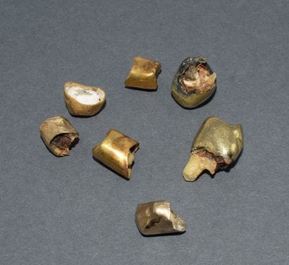 LOT OF DENTAL CROWNS in 18k (750/°°) yellow...