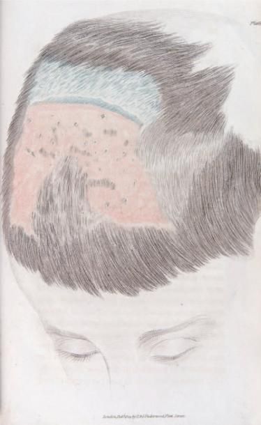 PLUMBE (SAMUEL)
Practical treatise on diseases...