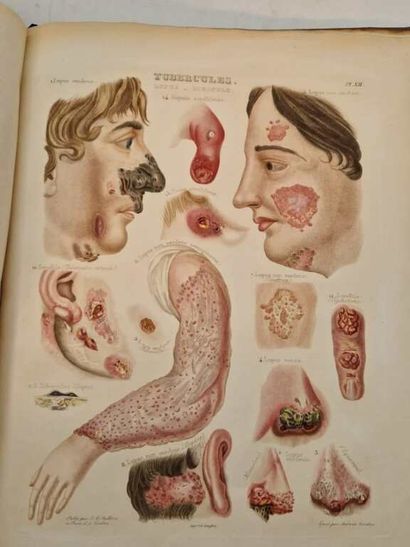 RAYER, Pierre. Traité des Maladies de la...