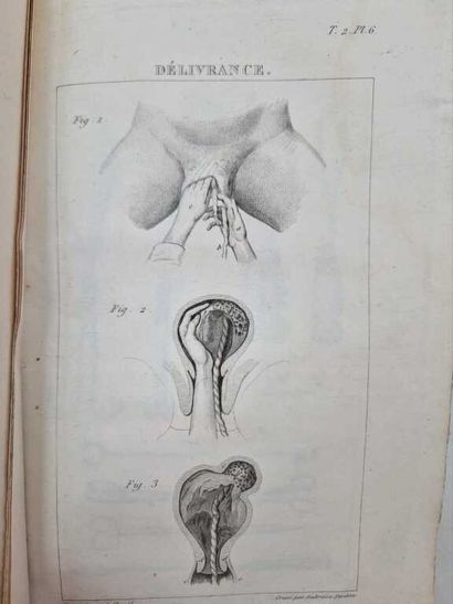 VELPEAU, Alfred-Armand-Louis-Marie. Traité...