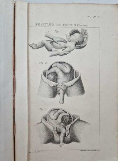 VELPEAU, Alfred-Armand-Louis-Marie. Traité...