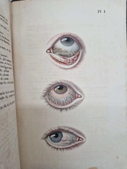 SICHEL, Jules. Traité de l'Ophthalmie, la...