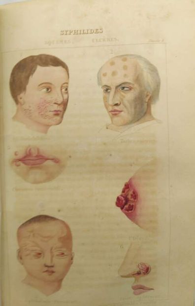 GIRAUDEAU, Jean. Traité des maladies venériennes...