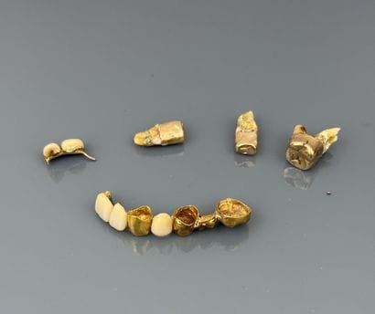 Lot of dental debris in 20k and 18k dental...