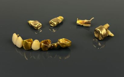 Lot of dental debris in 20k and 18k dental...