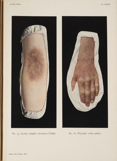 JACOBI
Atlas des maladies de la peau et des...